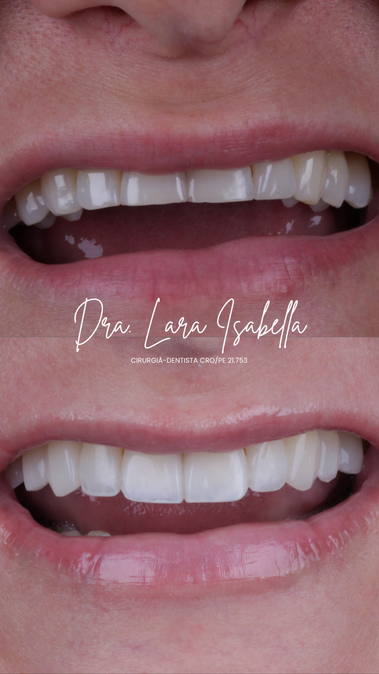 Resultado de facetas em resina em detalhe do sorriso
