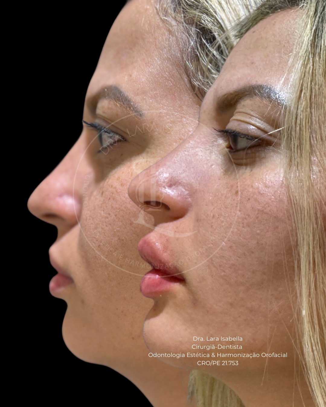 Resultado real de perfil facial com antes e depois