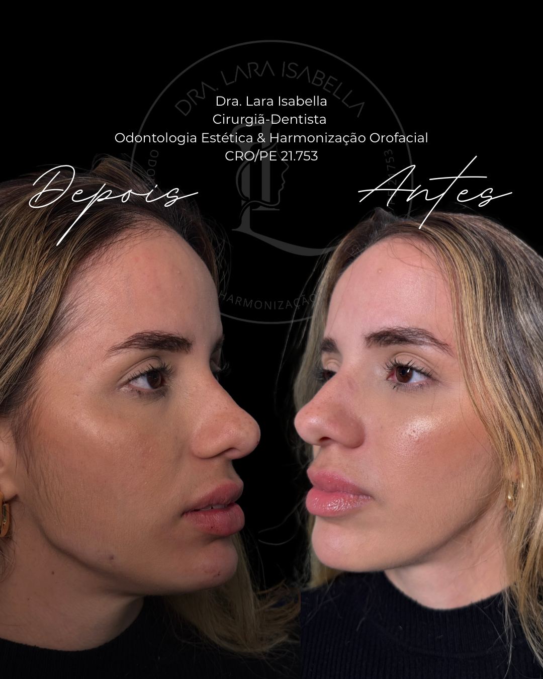 Resultado real de harmonização orofacial antes e depois
