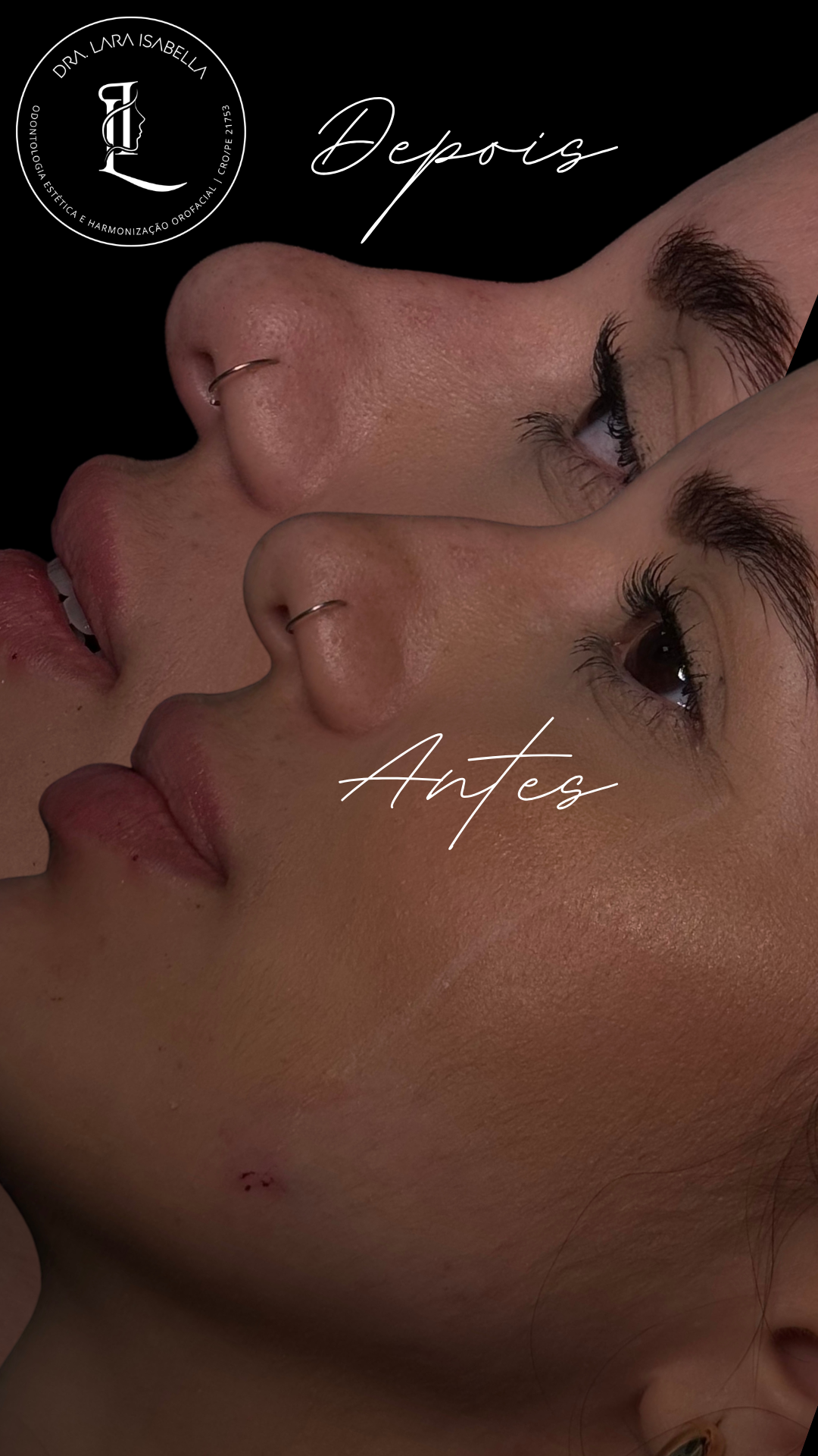 Resultado real de harmonização orofacial em perfil antes e depois