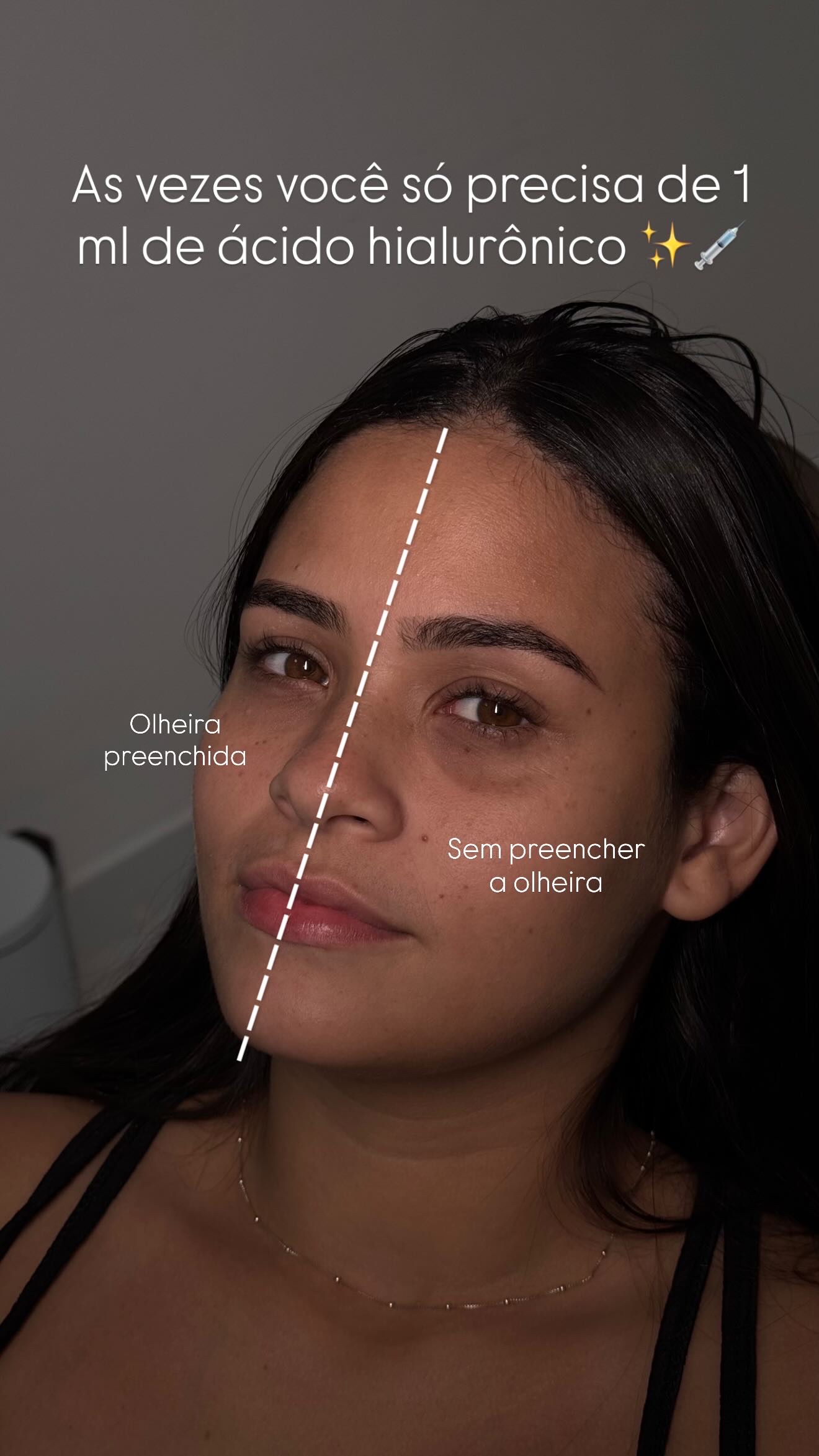 Comparativo de preenchimento de olheira em rosto feminino